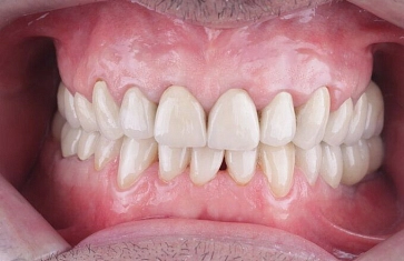 Восстановления эстетики винирами
